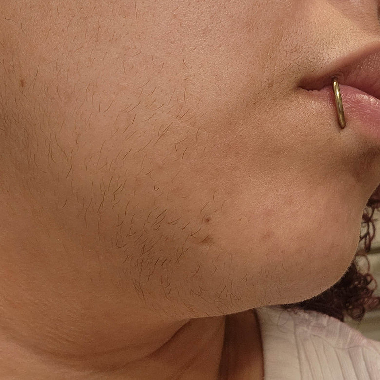 10 Safe Ways to Tackle PCOS Chin Hair